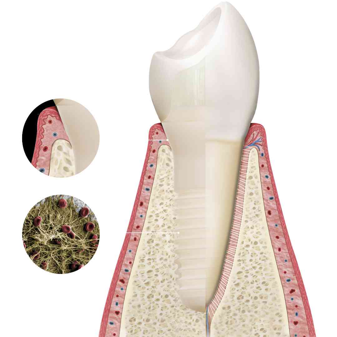 The machined transgingival neck of the implant permits a particularly high degree of soft-tissue adaptation, protecting the healing bone beneath and reducing marginal bone loss; with Patent™ implants, highly predictable and successful osseointegration is achieved; the Patent™ Dental Implant System is available in one- and two-piece configuration